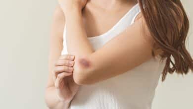 Why Do Your Bruises Change Color?