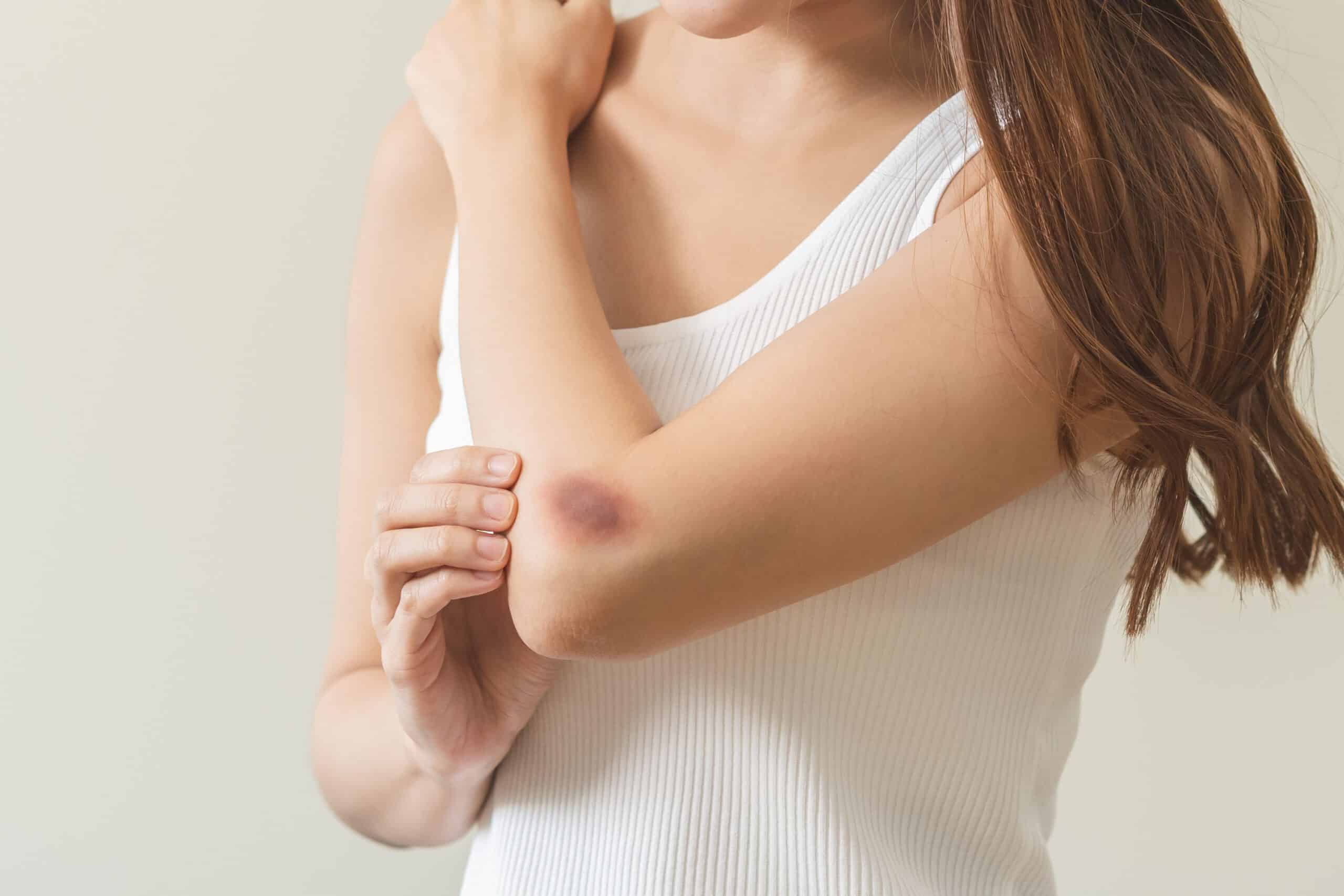 Why Do Your Bruises Change Color?